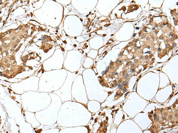 Immunohistochemistry of paraffin-embedded Human breast cancer tissue  using UBE2Z Polyclonal Antibody at dilution of 1:35(?200)