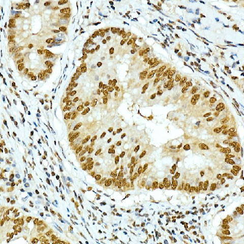 Immunohistochemistry of paraffin-embedded human colon carcinoma using Histone H4 Polyclonal Antibody at dilution of 1:250 (40x lens).Perform high pressure antigen retrieval with 10 mM citrate buffer pH 6.0 before commencing with IHC staining protocol.