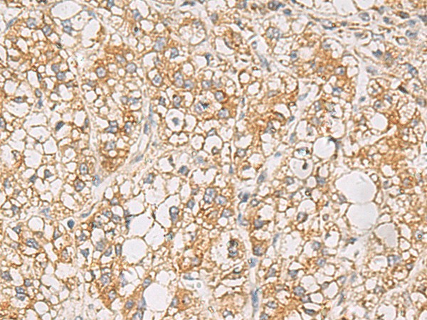 Immunohistochemistry of paraffin-embedded Human liver cancer tissue  using PTPRN Polyclonal Antibody at dilution of 1:55(?200)