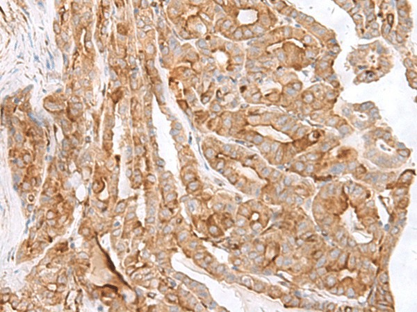 Immunohistochemistry of paraffin-embedded Human thyroid cancer tissue  using MCAM Polyclonal Antibody at dilution of 1:40(?200)