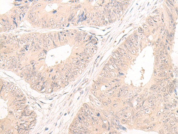 Immunohistochemistry of paraffin-embedded Human colorectal cancer tissue  using LCMT2 Polyclonal Antibody at dilution of 1:55(?200)