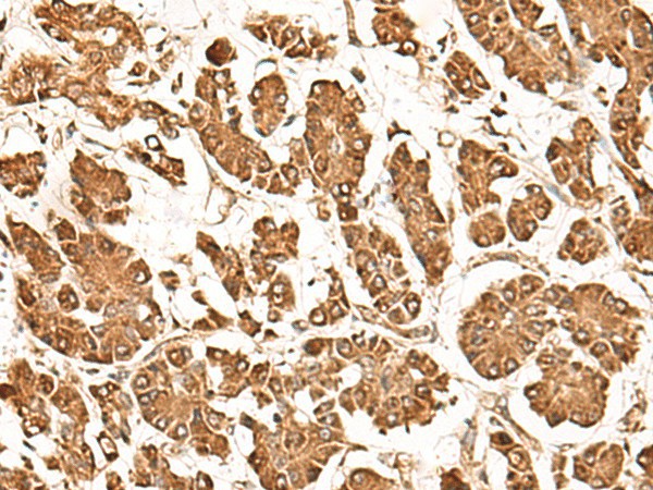 Immunohistochemistry of paraffin-embedded Human gastric cancer tissue  using ZBTB43 Polyclonal Antibody at dilution of 1:40(?200)