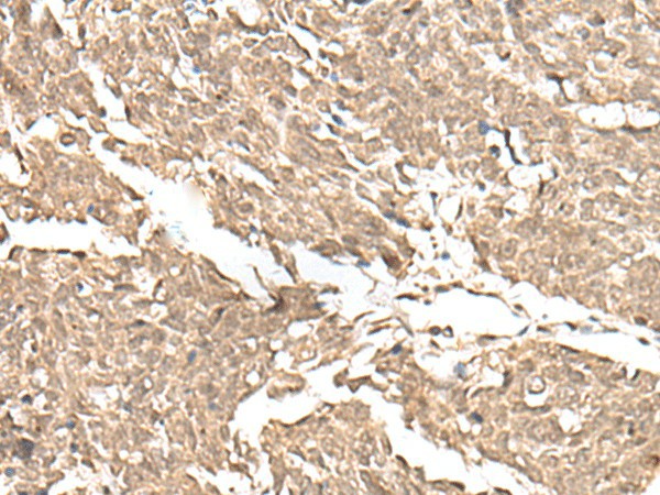 Immunohistochemistry of paraffin-embedded Human lung cancer tissue  using KDM2A Polyclonal Antibody at dilution of 1:55(?200)