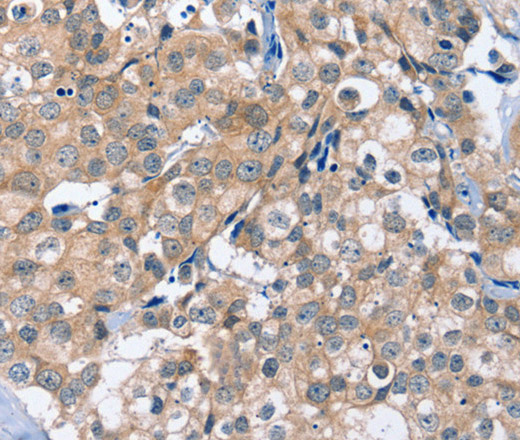 Immunohistochemistry of paraffin-embedded Human breast cancer using OTUB1 Polyclonal Antibody at dilution of 1:40