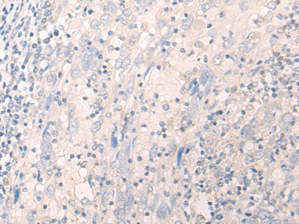 Immunohistochemistry of paraffin-embedded Human cervical cancer tissue  using LILRA2 Polyclonal Antibody at dilution of 1:40(?200)