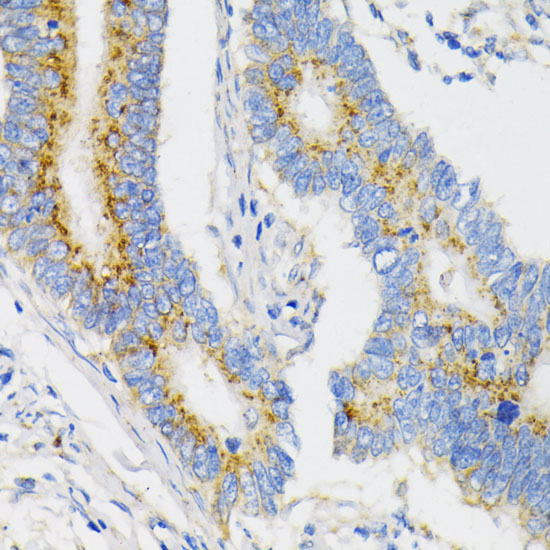 Immunohistochemistry of paraffin-embedded Human colon carcinoma using USO1 Polyclonal Antibody at dilution of 1:100 (40x lens).