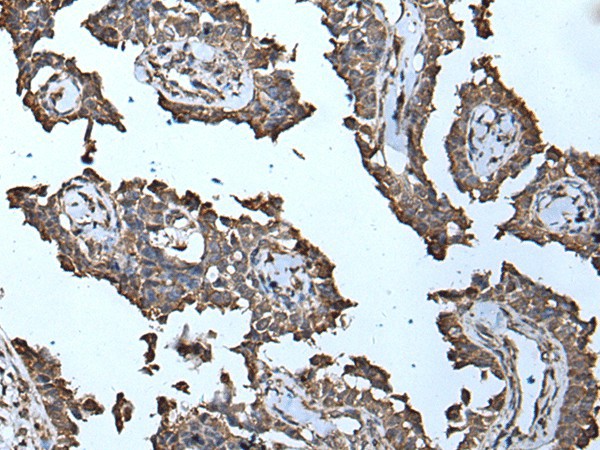 Immunohistochemistry of paraffin-embedded Human ovarian cancer tissue  using MCM10 Polyclonal Antibody at dilution of 1:50(?200)