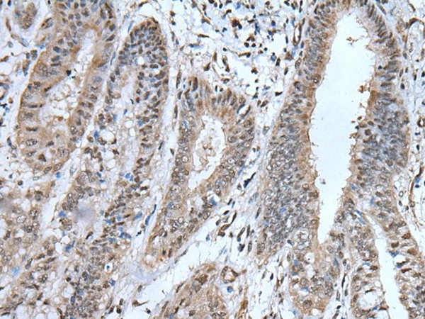 Immunohistochemistry of paraffin-embedded Human liver cancer tissue  using UBA52 Polyclonal Antibody at dilution of 1:55(?200)