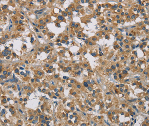 Immunohistochemistry of paraffin-embedded Human thyroid cancer tissue using STAT4 Polyclonal Antibody at dilution 1:30