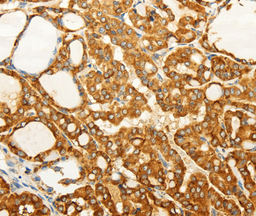 Immunohistochemistry of paraffin-embedded Human thyroid cancer tissue using FZD6 Polyclonal Antibody at dilution 1:60