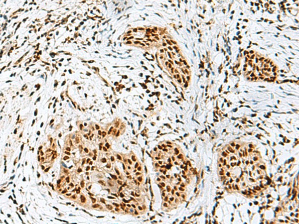 Immunohistochemistry of paraffin-embedded Human esophagus cancer tissue  using RBM10 Polyclonal Antibody at dilution of 1:50(?200)