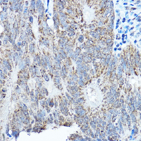 Immunohistochemistry of paraffin-embedded human colon carcinoma using SMOC1 Polyclonal Antibody at dilution of 1:200 (40x lens).Perform high pressure antigen retrieval with 10 mM citrate buffer pH 6.0 before commencing with IHC staining protocol.