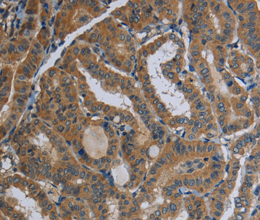 Immunohistochemistry of paraffin-embedded Human thyroid cancer tissue using FAAH Polyclonal Antibody at dilution 1:40