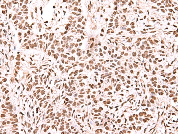 Immunohistochemistry of paraffin-embedded Human ovarian cancer tissue  using NASP Polyclonal Antibody at dilution of 1:60(?200)