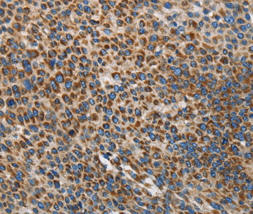 Immunohistochemistry of paraffin-embedded Human liver cancer using UPF1 Polyclonal Antibody at dilution of 1:35