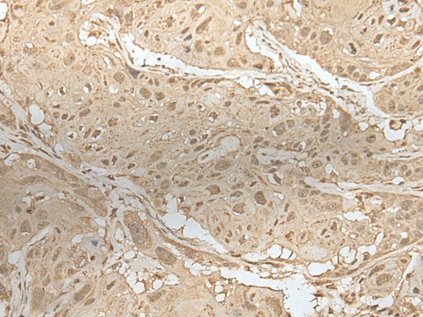 Immunohistochemistry of paraffin-embedded Human esophagus cancer tissue  using ZBTB18 Polyclonal Antibody at dilution of 1:50(?200)