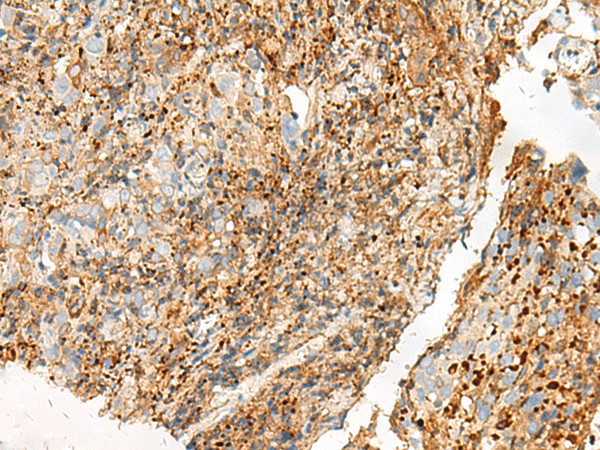 Immunohistochemistry of paraffin-embedded Human cervical cancer tissue  using GPR27 Polyclonal Antibody at dilution of 1:25(?200)