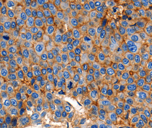 Immunohistochemistry of paraffin-embedded Human esophagus cancer using Claudin 1 Polyclonal Antibody at dilution of 1:150