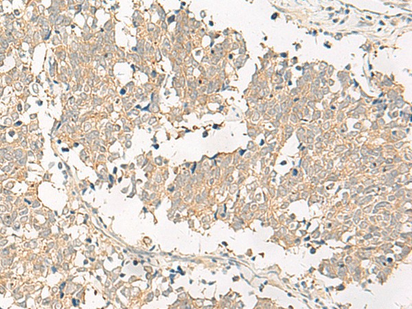 Immunohistochemistry of paraffin-embedded Human lung cancer tissue  using GPR161 Polyclonal Antibody at dilution of 1:40(?200)