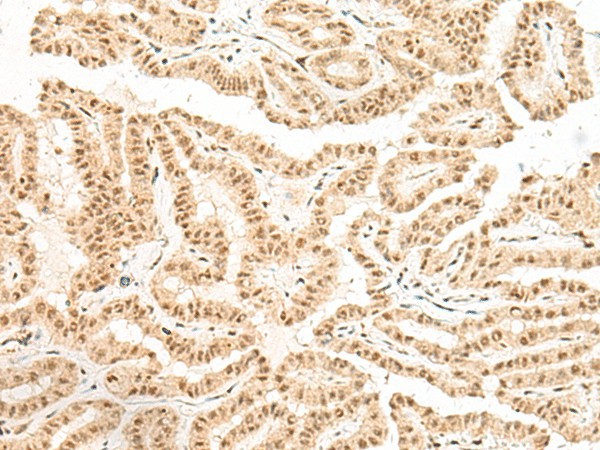 Immunohistochemistry of paraffin-embedded Human thyroid cancer tissue  using BICRA Polyclonal Antibody at dilution of 1:40(?200)