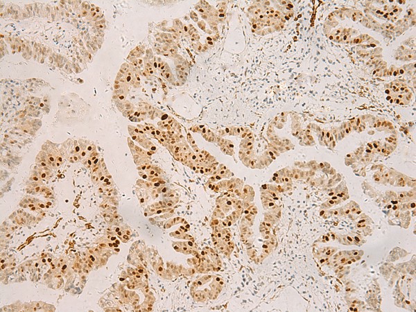 Immunohistochemistry of paraffin-embedded Human liver cancer tissue  using RFX6 Polyclonal Antibody at dilution of 1:50(?200)