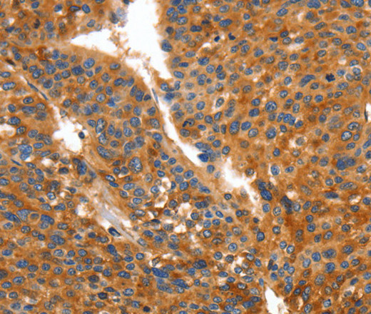 Immunohistochemistry of paraffin-embedded Human liver cancer using ORM2 Polyclonal Antibody at dilution of 1:50