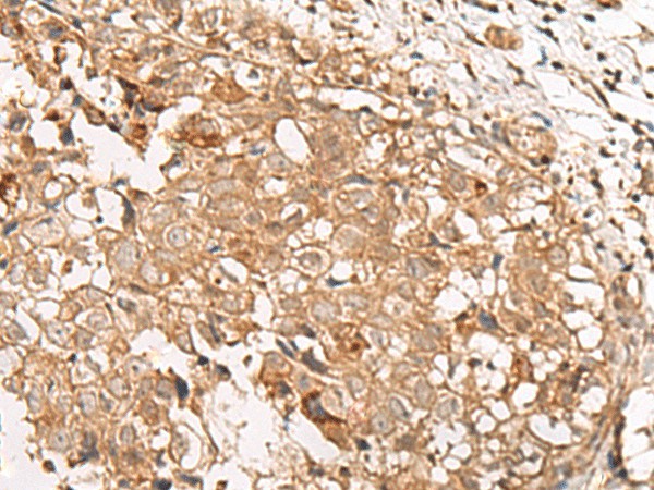 Immunohistochemistry of paraffin-embedded Human breast cancer tissue  using GBGT1 Polyclonal Antibody at dilution of 1:40(?200)