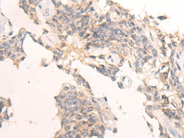 Immunohistochemistry of paraffin-embedded Human ovarian cancer tissue  using IBA57 Polyclonal Antibody at dilution of 1:65(?200)