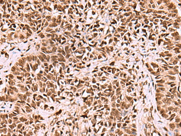 Immunohistochemistry of paraffin-embedded Human ovarian cancer tissue  using LDB1 Polyclonal Antibody at dilution of 1:70(?200)