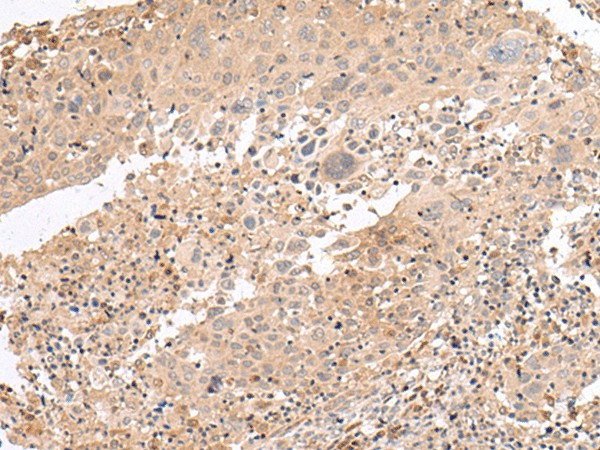 Immunohistochemistry of paraffin-embedded Human cervical cancer tissue  using PATJ Polyclonal Antibody at dilution of 1:45(?200)