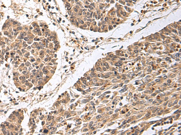 Immunohistochemistry of paraffin-embedded Human colorectal cancer tissue  using CD24 Polyclonal Antibody at dilution of 1:25(?200)