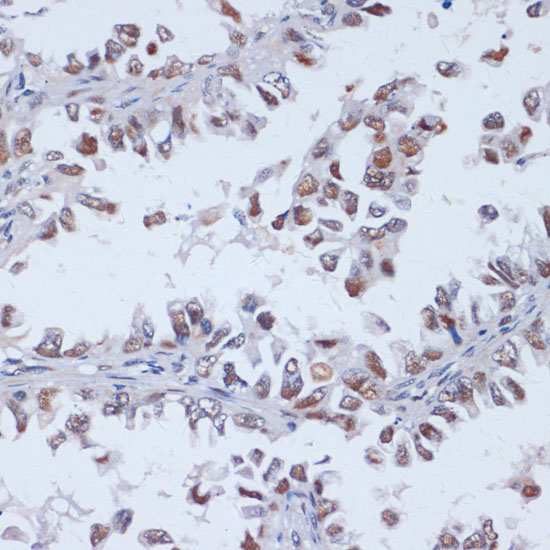 Immunohistochemistry of paraffin-embedded human lung cancer using DNMT3L Polyclonal Antibody at dilution of 1:100 (40x lens).Perform microwave antigen retrieval with 10 mM PBS buffer pH 7.2 before commencing with IHC staining protocol.