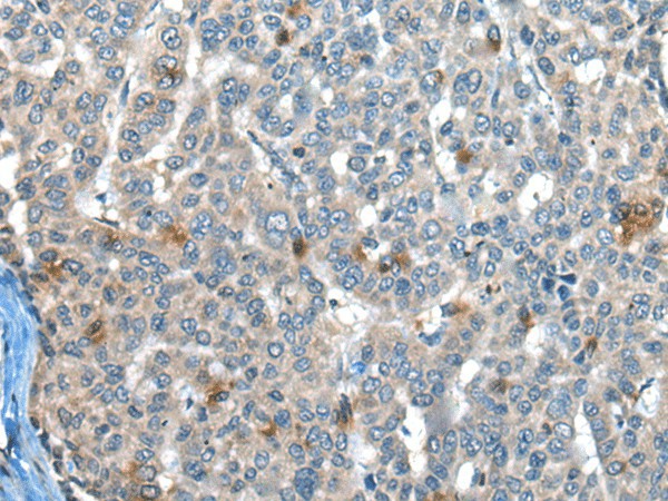 Immunohistochemistry of paraffin-embedded Human liver cancer tissue  using CAPN3 Polyclonal Antibody at dilution of 1:30(?200)