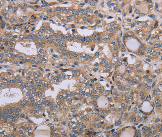 Immunohistochemistry of paraffin-embedded Human thyroid cancer tissue using NAA25 Polyclonal Antibody at dilution 1:40