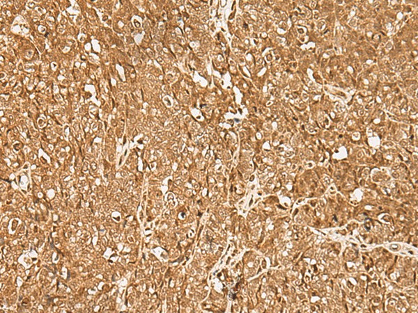 Immunohistochemistry of paraffin-embedded Human ovarian cancer tissue  using GMEB2 Polyclonal Antibody at dilution of 1:35(?200)