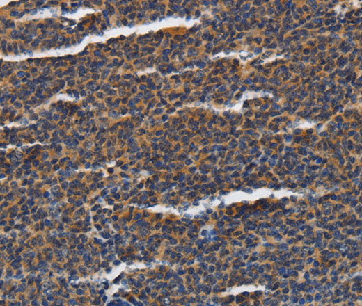 Immunohistochemistry of paraffin-embedded Human lymphoma tissue using PIAS2 Polyclonal Antibody at dilution 1:70