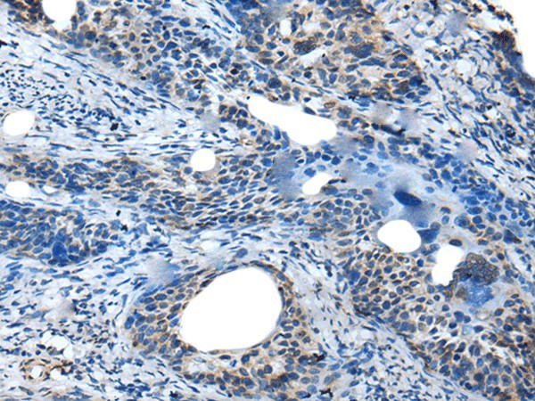 Immunohistochemistry of paraffin-embedded Human cervical cancer tissue  using SAA4 Polyclonal Antibody at dilution of 1:35(?200)