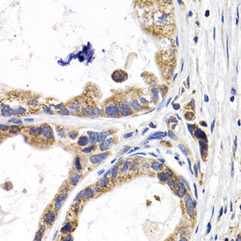 Immunohistochemistry of paraffin-embedded human stomach cancer using FABP3 Polyclonal Antibody at dilution of 1:200 (40x lens).Perform microwave antigen retrieval with 10 mM PBS buffer pH 7.2 before commencing with IHC staining protocol.