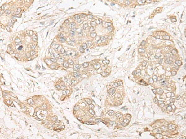 Immunohistochemistry of paraffin-embedded Human liver cancer tissue  using COMT Polyclonal Antibody at dilution of 1:30(?200)