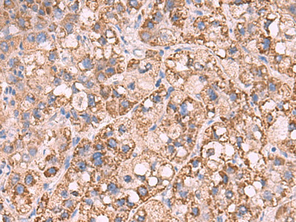 Immunohistochemistry of paraffin-embedded Human liver cancer tissue  using KCNN1 Polyclonal Antibody at dilution of 1:55(?200)