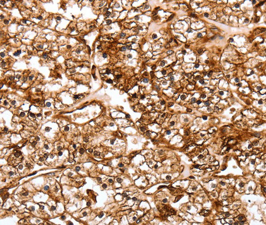 Immunohistochemistry of paraffin-embedded Human renal cancer tissue using SLC9A3R2 Polyclonal Antibody at dilution 1:40