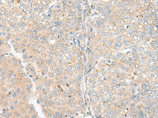 Immunohistochemistry of paraffin-embedded Human liver cancer tissue  using CAMK2A Polyclonal Antibody at dilution of 1:55(?200)