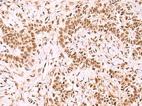 Immunohistochemistry of paraffin-embedded Human ovarian cancer tissue  using GPKOW Polyclonal Antibody at dilution of 1:100(?200)