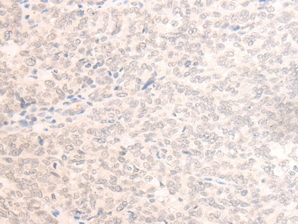 Immunohistochemistry of paraffin-embedded Human ovarian cancer tissue  using EME2 Polyclonal Antibody at dilution of 1:40(?200)