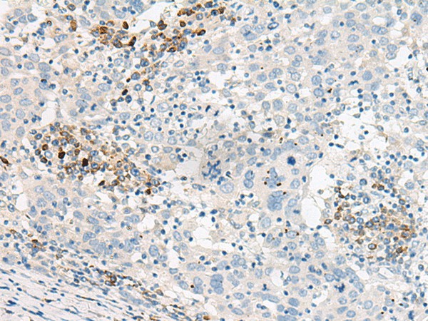 Immunohistochemistry of paraffin-embedded Human cervical cancer tissue  using GUCA1B Polyclonal Antibody at dilution of 1:45(?200)