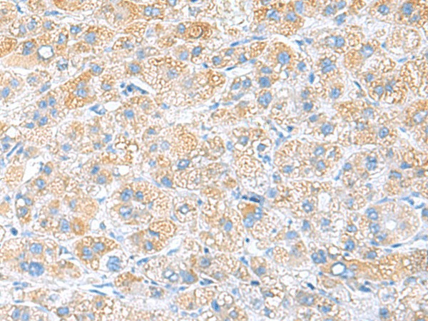 Immunohistochemistry of paraffin-embedded Human liver cancer tissue  using RPS16 Polyclonal Antibody at dilution of 1:65(?200)