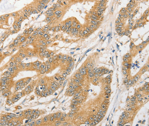 Immunohistochemistry of paraffin-embedded Human colon cancer tissue using ATG5 Polyclonal Antibody at dilution 1:40