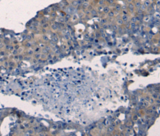 Immunohistochemistry of paraffin-embedded Human breast cancer tissue using FGF2 Polyclonal Antibody at dilution 1:50