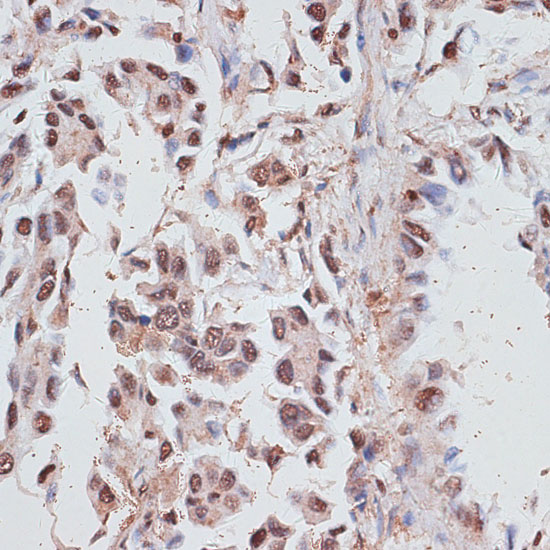 Immunohistochemistry of paraffin-embedded Human lung cancer using RPA1 Polyclonal Antibody at dilution of  1:100 (40x lens).