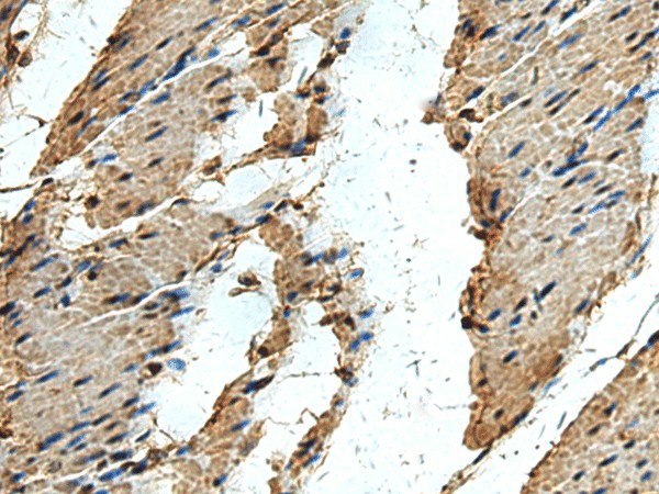 Immunohistochemistry of paraffin-embedded Human thyroid cancer tissue  using ERLIN1 Polyclonal Antibody at dilution of 1:50(?200)